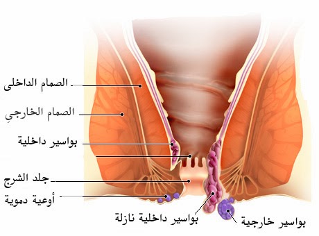 علاج البواسير